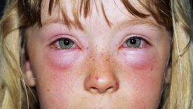 Allergiás gyerek